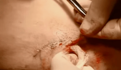 operāciju veidi varikozu vēnu noņemšanai