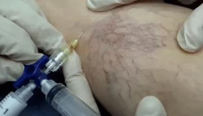 skleroterapija varikozām vēnām